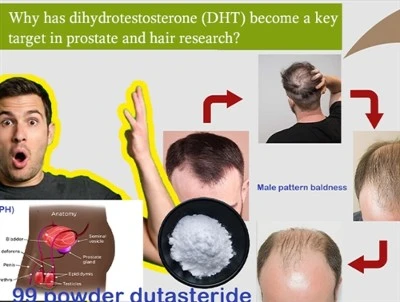 De ce a devenit DHT o țintă cheie în cercetarea prostatei și părului